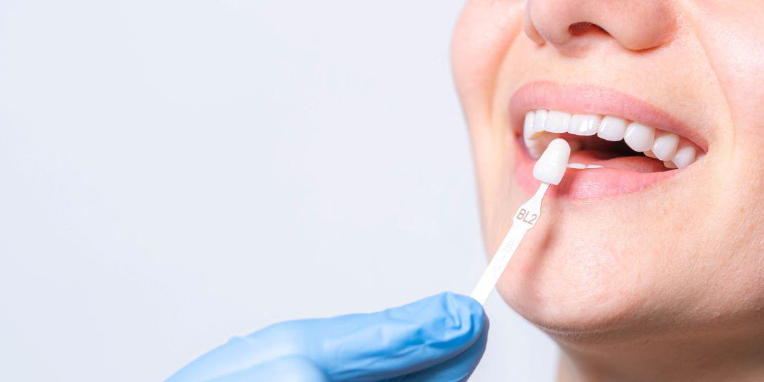 How To Take Care of Porcelain Veneers